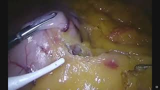 Sleeve Gastrectomy - CoolSeal Trinity
