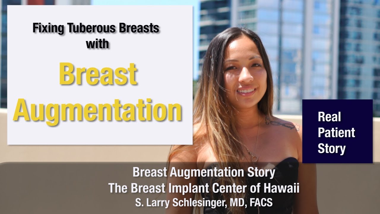 Breast Augmentation Patient Story - Embracing Life without Tuberous Breasts - Breast Implant Center of Hawaii
