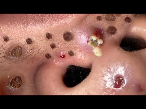 Blackhead Removal With Sac Dep Spa @100074089