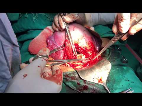 Cesarean delivery / C-section : Surgical technique - HD Video