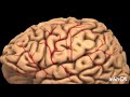 Acidente Vascular Cerebral (AVC) e Seus Efeitos