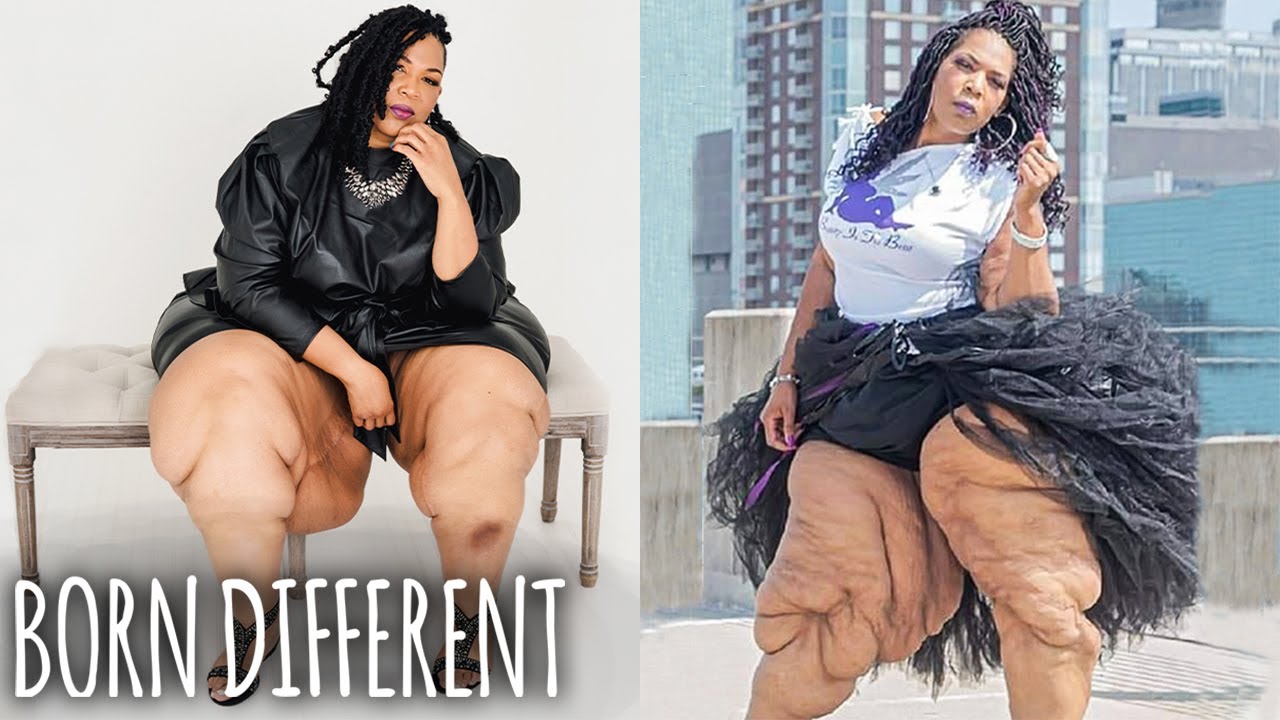 My legs will never stop growing - born different