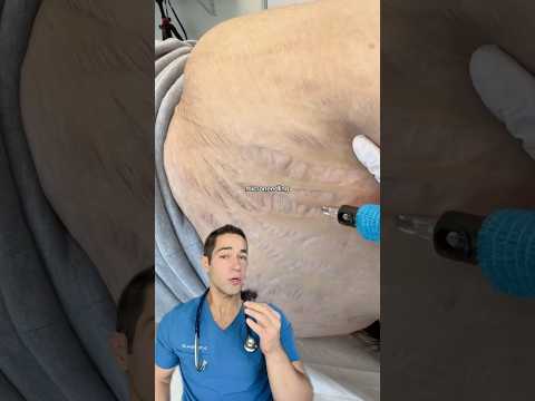 How does microneedling work? Doctor Explains