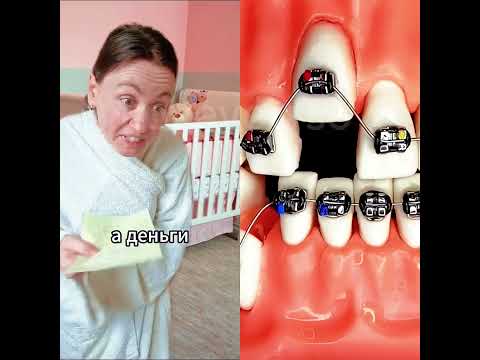 #braceslife #foryou #braces #funny #pov #storytime #mybracesjourney #fyr