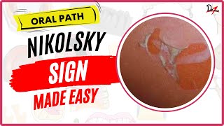 What the Nikolsky Sign Tells Us!