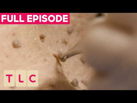 FULL EPISODE | Dr Emma Snips Off HUNDREDS Of Painful Skin Tags! | The Bad Skin Clinic