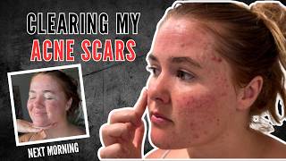 How I Cleared 99% of My Acne Scars at Home