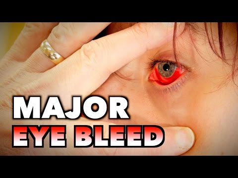 MAJOR EYE BLEED + (Possible Mono, Spleen Exam, & Blood Draw) | Dr. Paul