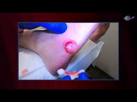 WCW: Debriding the Callus of a Diabetic Foot Ulcer