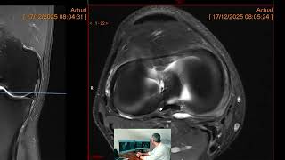 Analizando una resonancia magnética de la interlínea interna de la rodilla