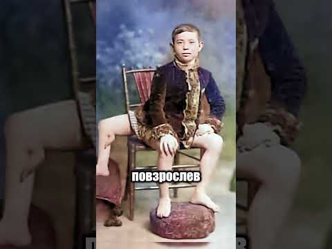 Шокирующая история сросшихся близнецов! 🤯👶👶