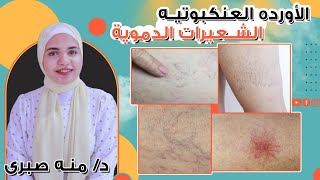 التخلص من الشعيرات الدموية و الأوردة العنكبوتيه  و الدوالي