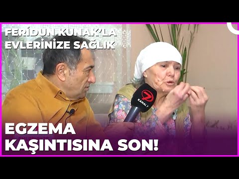 Egzama Belasının Tedavisi! | Dr. Feridun Kunak’la Evlerinize Sağlık