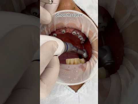 full <strong>vedio</strong> of full-arch implant #dentist #dentalprosthesis #dental #dentistry #implants