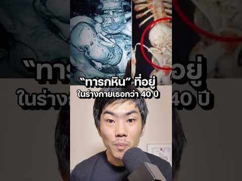 เธอคนนี้พบ ทารกหิน อยู่ในท้อง เพราะสิ่งนี้? #science #saysci #ความรู้ #สาระ