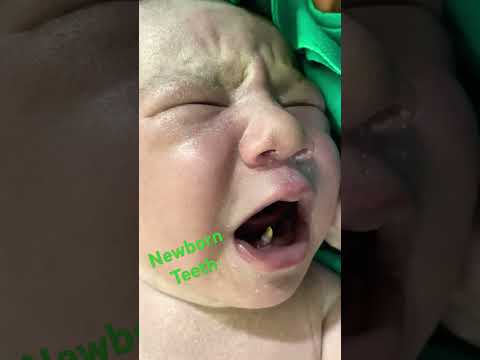Newborn Teeth |#baby #teeth #newbornteeth #shortsvideo #drpoonammaggo