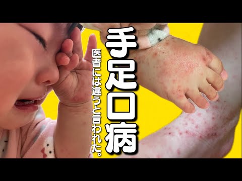 【助けて】手足口病がマジで辛すぎる....