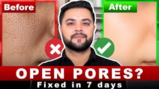 7 Days Open Pores Treatment: Blackheads, Enlarged Pores & Acne Treatment 