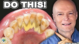 #1 Absolute Best Way to Stop Tartar