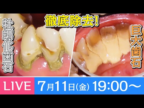 巨大牡蠣化歯石除去ライブ‼️ 掛け声はオイスター‼️