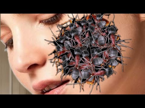 What happened to the cheek? Cheek infested ASMR larvae 2D animation |ASMR Worm infection asmr