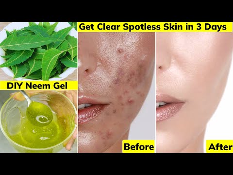 I applied👆🏼this Face Cream Gel on Acne, Pimples, Pigmentation,Bumps-Got Clear Glowing Skin in 3 Days