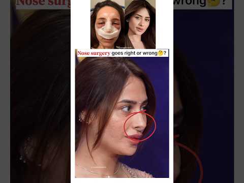 Surgery goes right or wrong🤔? #shorts #mahirasharma #bollywood #cosmeticsurgery #rhinoplasty