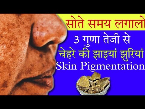 8 दिन में पुरानी jhaiya ,झुरियां,Skin Pigmentation,melasma को तेजी से ख़त्म करने का तरीका ।