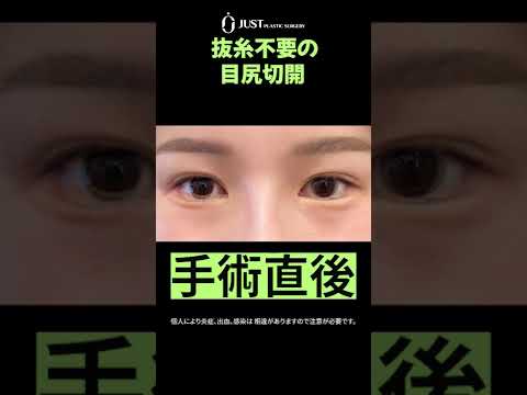 ✨1ヶ月目の変化チェック✨目尻切開ってどんな感じ?👀