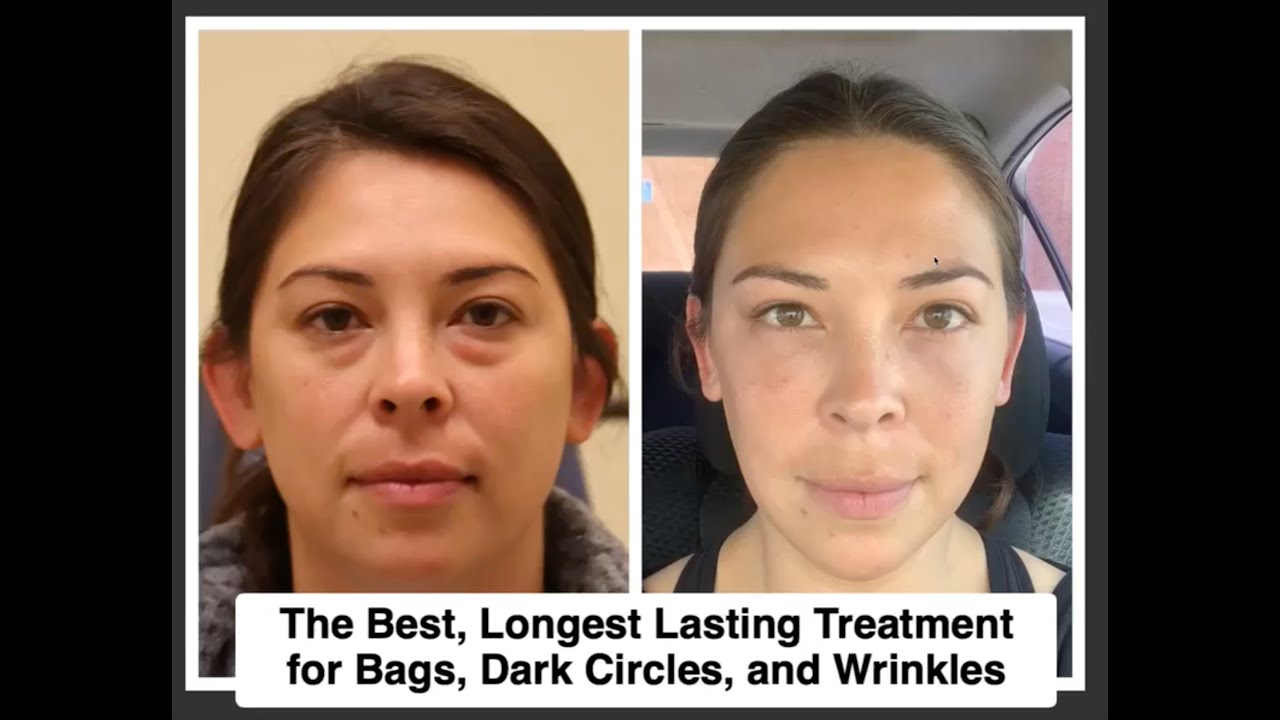 Before and after skincare treatment comparison image.