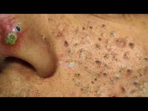 Blackhead Removal With Sac Dep Spa @100074097