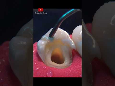 ¿Cómo eliminar las caries? #shorts