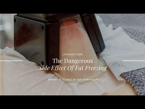 The Dangerous Side Effect Of Fat Freezing