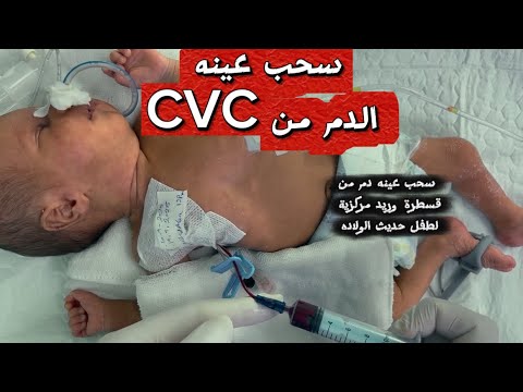 سحب عينة دم من قسطرة وريد مركزي( من CVC ) بشكل صحيح