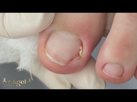 😫 A UNHA RASGOU O DEDO DELE POR DENTRO   #satisfying #viral