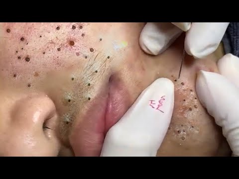 Big Cystic Acne Blackheads Extraction Blackheads & Milia, Whiteheads Removal Pimple Popping # 433