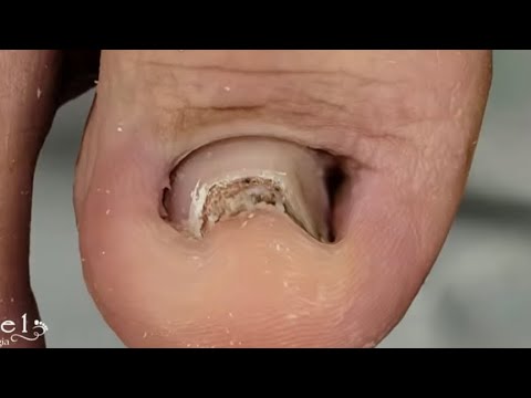 O QUE SERÁ ISSO PRETO NESSA UNHA??😱 Deu Trabalho Pra Desencravar 🥵 Podologa Nagel #podologia