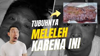 Heboh! Hisashi Ouchi Alami Kematian Paling Menyakitkan di Dunia #dampak #penyakit #hisashiouchi