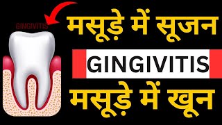 दांत और मसूड़े सड़ने की होम्योपैथिक दवा || Homeopathic medicine For Swollen Teeth, Gums