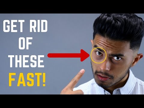 Get Rid of Bags and Dark Eye Circles FAST | 4 Easy At Home Remedies