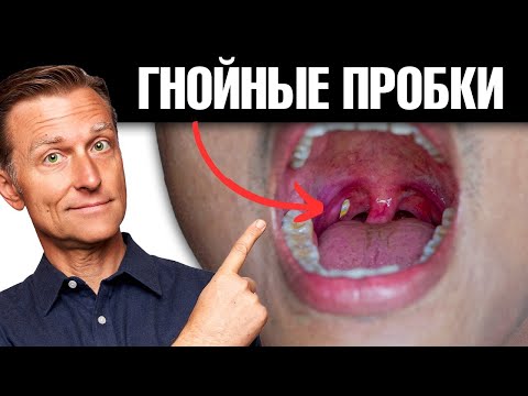Как избавиться от гнойных пробок в горле навсегда? 🧐