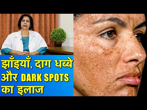 झाँइयाँ, Dark Spots और दाग धब्बों का इलाज || Hyperpigmentation Treatment