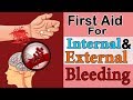 First Aid for Bleeding Situations
