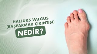 Halluks Valgus (Başparmak Çıkıntısı) Nedir?