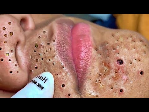 Big Cystic Acne Blackheads Extraction Blackheads & Milia, Whiteheads Removal Pimple Popping # 3914