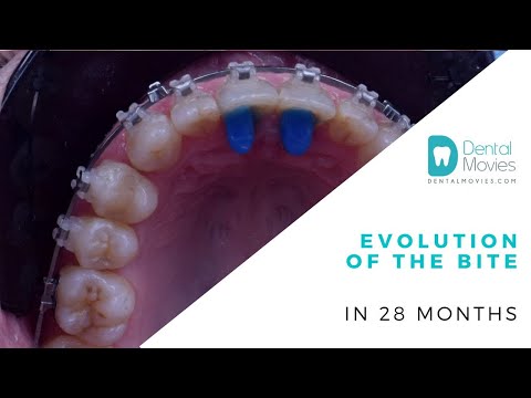 Evolution of the bite in 28 months