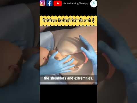 Cesarean Delivery #shorts #baby