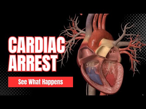 What Happens During Cardiac Arrest (3D Animation)