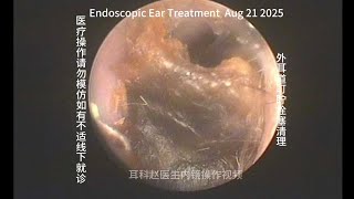 Common External Ear Canal Cerumen Embolism Clearance 20250821