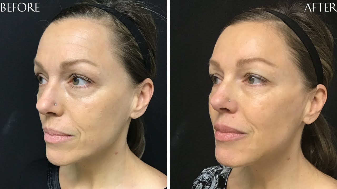 Preview of Dermal filler and Botox Cosmetic®: Carol 50 y.o.